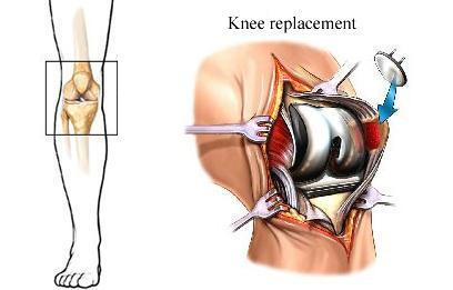 20150109131118_Total-Knee-Replacement-TKR.jpg